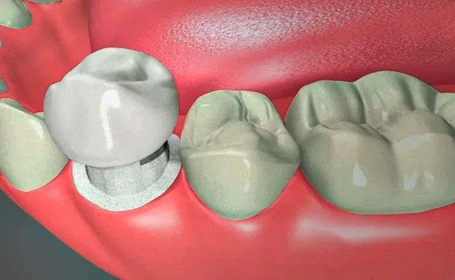 3D illustration of a porcelain posterior tooth crown