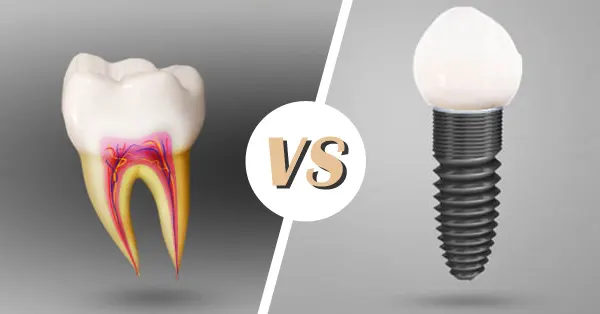 Root Canals vs. Dental Implants: Which Is Best?