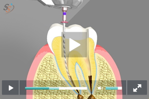 Root Canal Treatment Root Canal Treatment