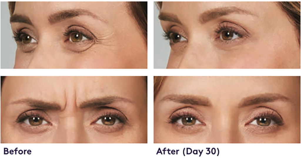 before and after photos of eyes with and with reduced frown lines after 30 days.