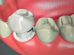 Dental Crowns Dental Crowns