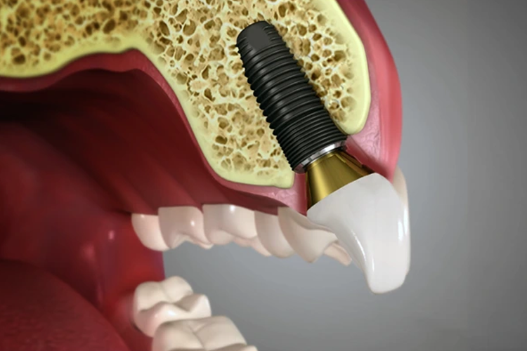 Dental Implants