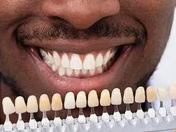 Dental Veneers Dental Veneers