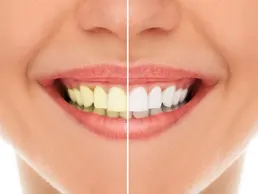Teeth Whitening Teeth Whitening